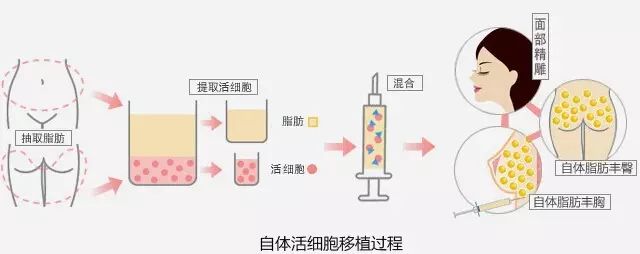 武漢美博會之自體脂肪移植過程
